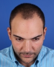 Before Hair Transplant&nbsp;Front